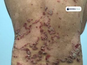 Placche di psoriasi circinate