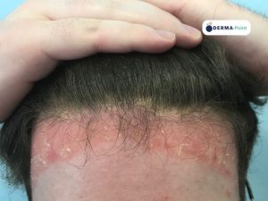 Psoriasi del cuoio capelluto e della regione frontale