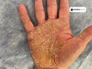 Psoriasi palmare ipercheratosica
