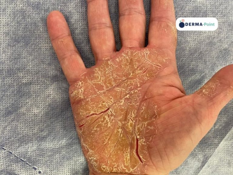 Psoriasi palmare ipercheratosica