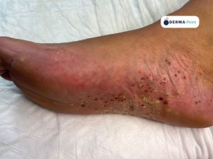 Psoriasi pustolosa plantare