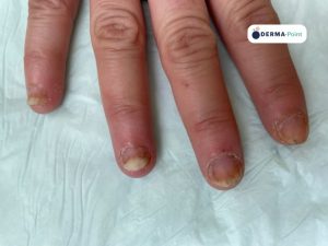 Psoriasi ungueale con unghie spesse