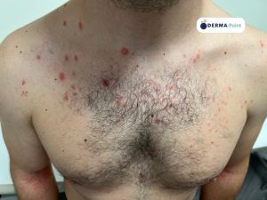 Psorasi guttata in risoluzione