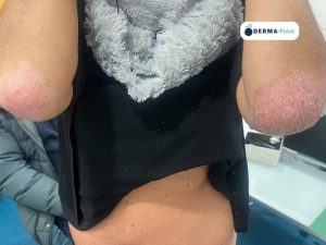 Psoriasi dei gomiti