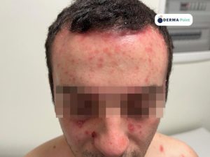 Psoriasi del cuoio capelluto e del volto