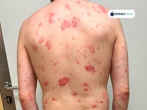 Psoriasi pustolosa sulla schiena