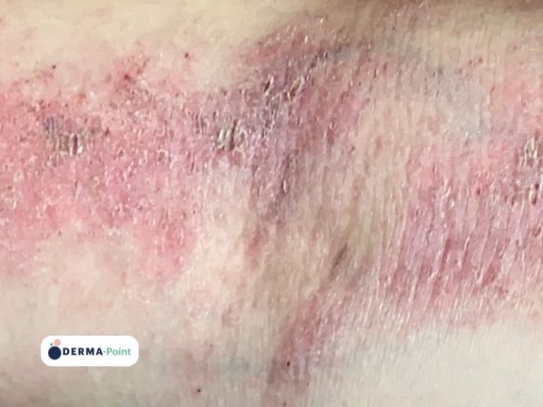 Dermatite atopica a livello del cavo popliteo