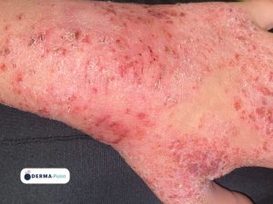 Dermatite atopica sul dorso della mano