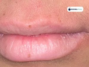 Dermatite atopica sulla regione periorale