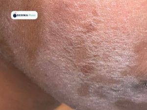 Dermatite atopica con placche sul volto