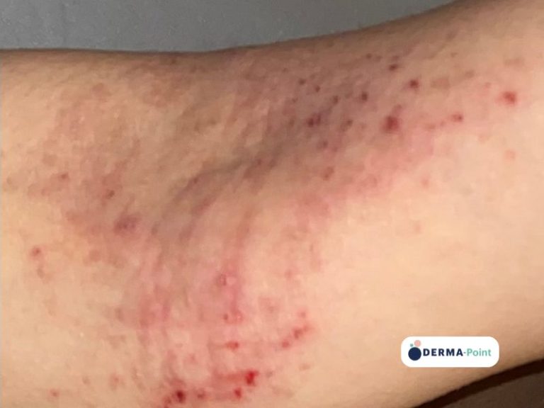 Dermatite atopica sulla regione antecubitale