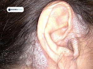 Psoriasi a placche del cuoio capelluto