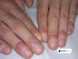 Psoriasi delle mani e delle unghie
