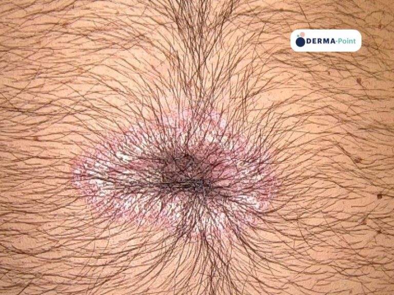Onfalite psoriasica