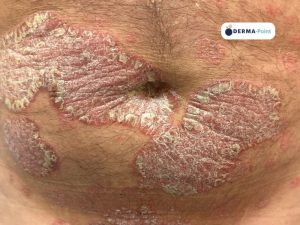 Placche psoriasiche sull’addome