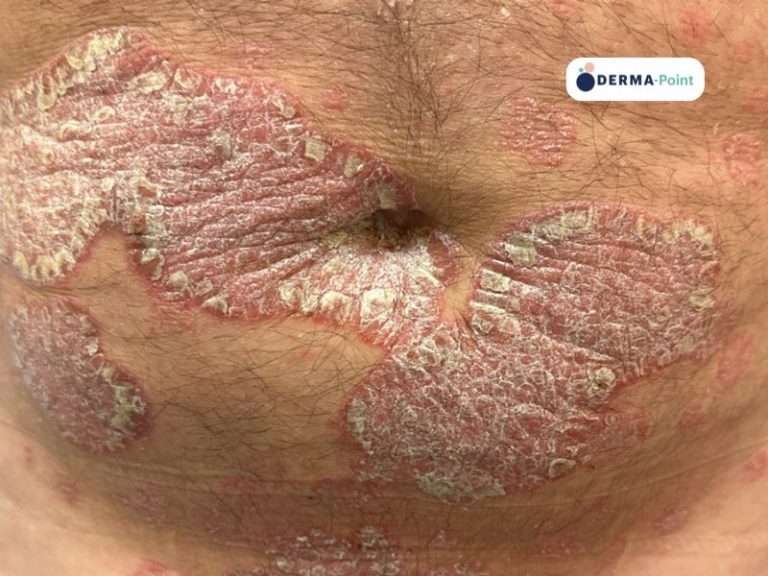 Placche psoriasiche sull’addome