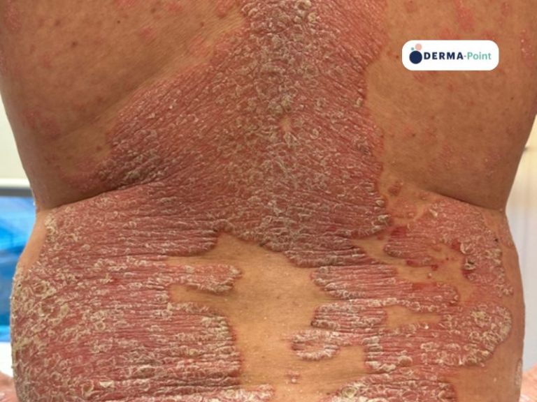 Placche psoriasiche sul dorso