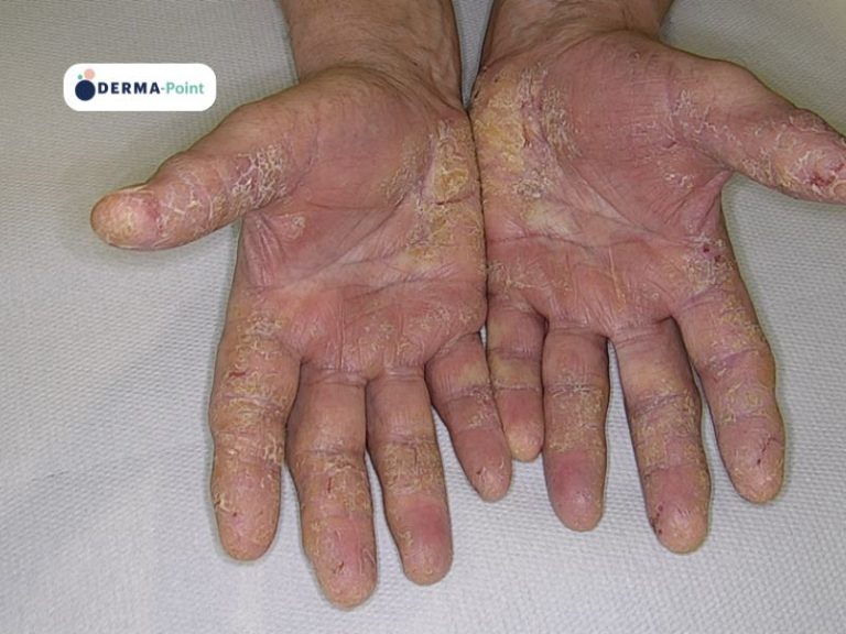 Psoriasi del palmo delle mani