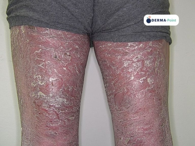 Psoriasi eritrodermica: forma grave