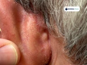 Psoriasi in sede retroauricolare