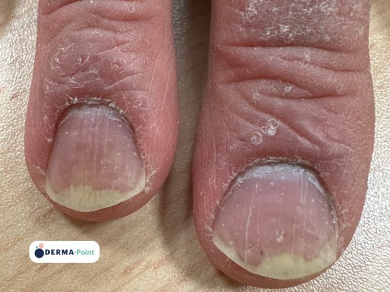 Tipiche manifestazioni ungueali della psoriasi