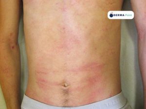 Dermatite atopica: xerosi diffusa e aree eczematose sul busto