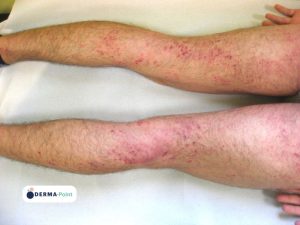 Dermatite atopica: aree eczematose ed escoriazioni sulle gambe