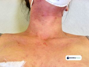 Dermatite atopica con eczema e xerosi sul collo