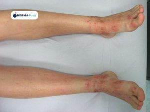 Dermatite atopica con segni di grattamento sui piedi