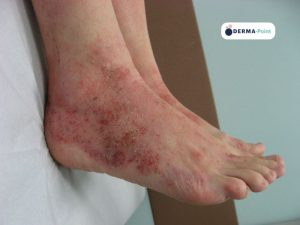 Dermatite atopica con lesioni sui piedi