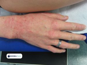 Dermatite atopica con lesioni sulle mani