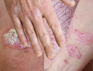 Patologie associate alla psoriasi