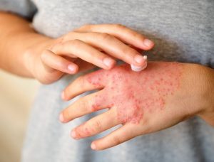 Terapia fondamentale per la dermatite atopica