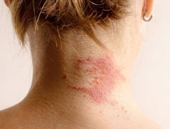 Dermatite atopica e allergia