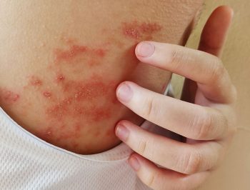 dermatite-atopica-cosa-non-fare- Dermatite atopica cosa non fare